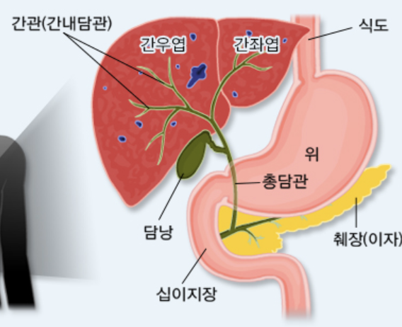 간경화 초기증상 1
