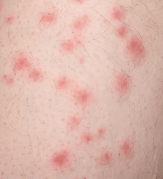 빈대에 물려 여러군데 울긋불긋한 모양