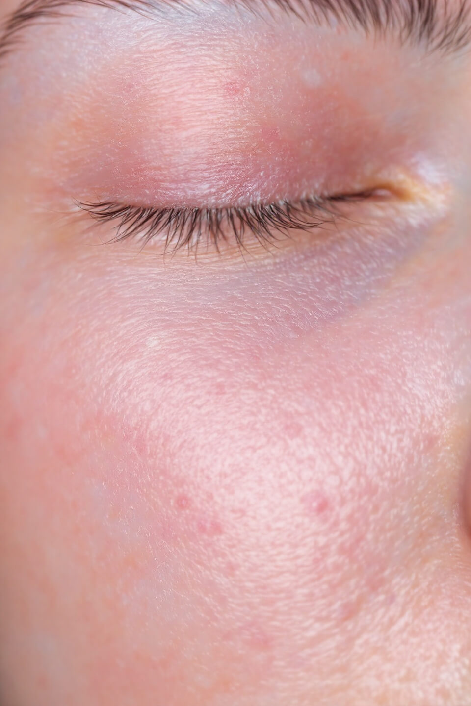 비립종과 관련된 사진입니다.