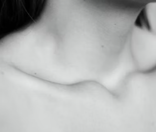 갑상선 기능 저하증 증상 원인 치료법