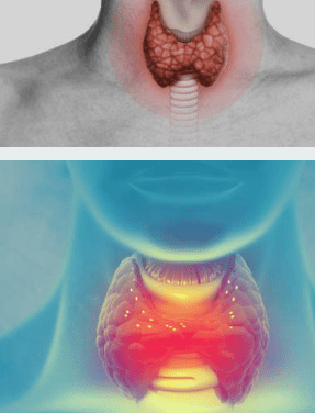갑상선 기능 저하증 증상