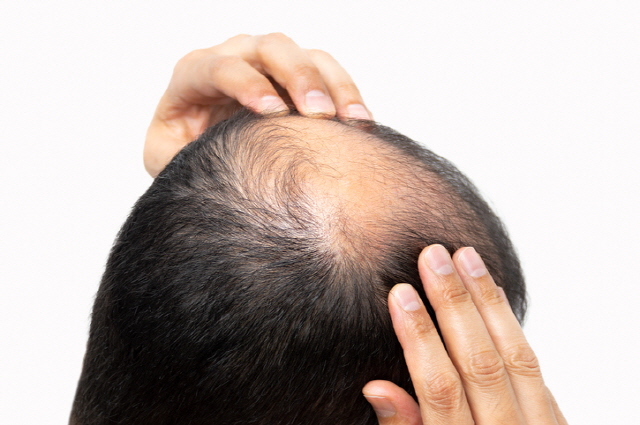 머리숱이-정수리에-없는-사람