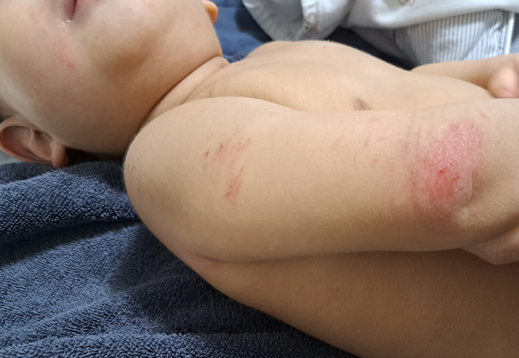 아기 아토피, 임신 후기부터 관리 방법 (feat. 모유수유와 아토피 상관관계?)