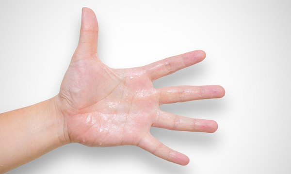 다한증 관련 사진