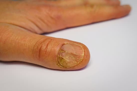 손톱 손상 – 원인, 증상 및 치료 방법