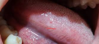 혓바늘 없애는 방법