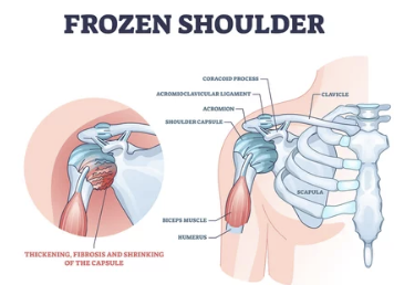 Frozen Shoulder