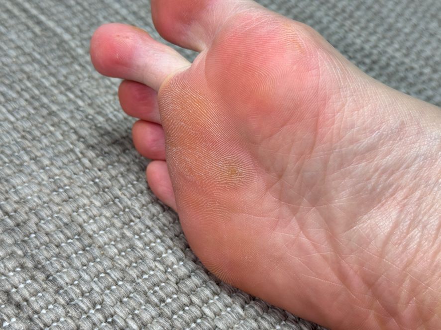 발바닥 엔드와츠 치료 결과 완치된 족저사마귀