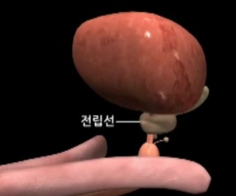 전립선암3
