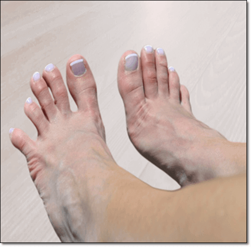 망치족지 예방 운동