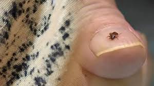 빈대 물린자국 : 빈대 퇴치법&amp;#44; 증상&amp;#44; 예방법