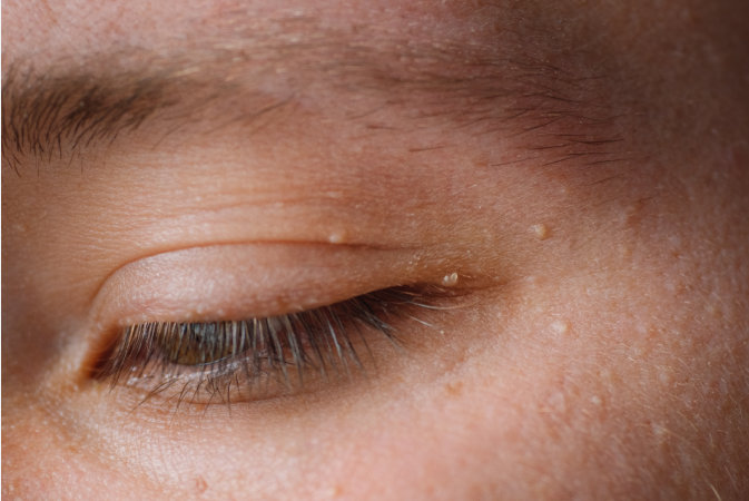 비립종 없애는 방법