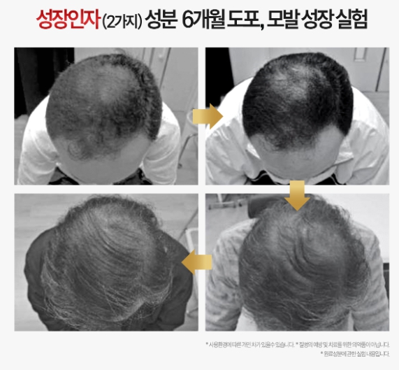 줄기세포-탈모치료제-리맨틱5