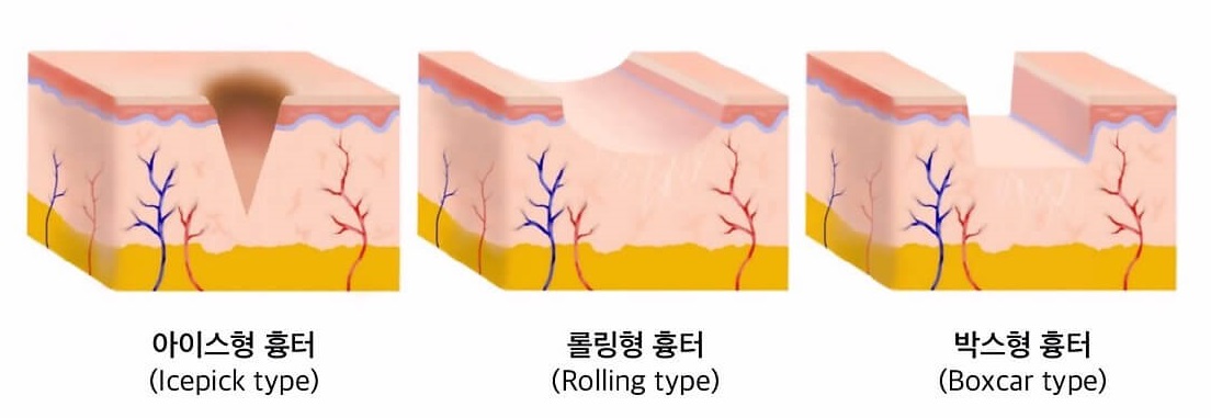 위축성 흉터 종류