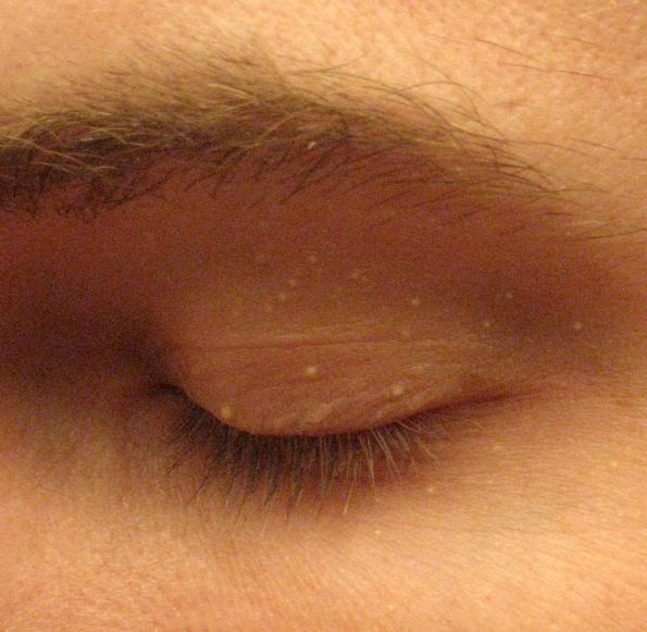 비립종 원인 생기는 이유 5가지