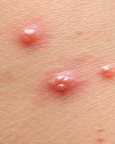 대상포진 초기증상