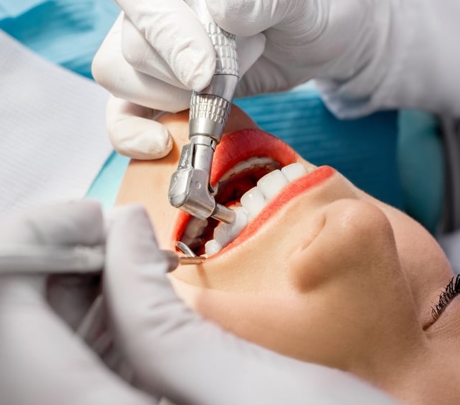 치과에서 스케일링하는 중