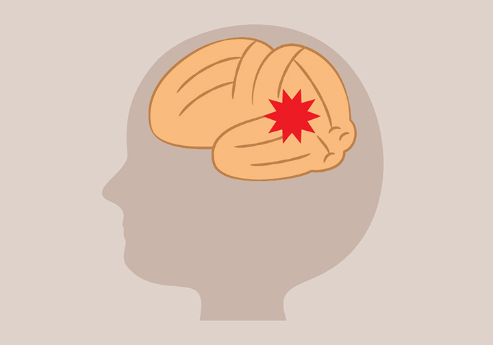 출혈성-뇌졸중-모습