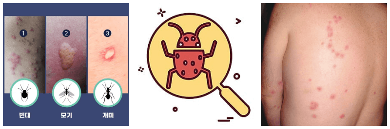 빈대 물린 자국, 빈대 포토