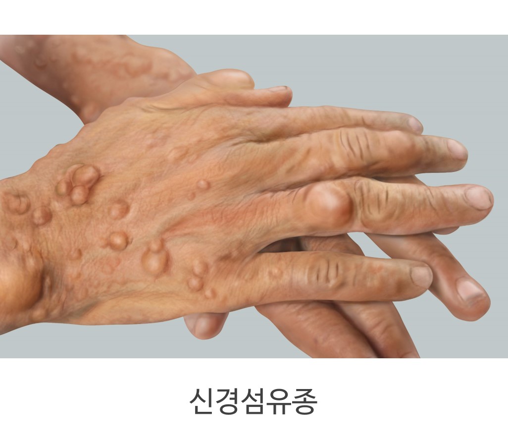 신경섬유종