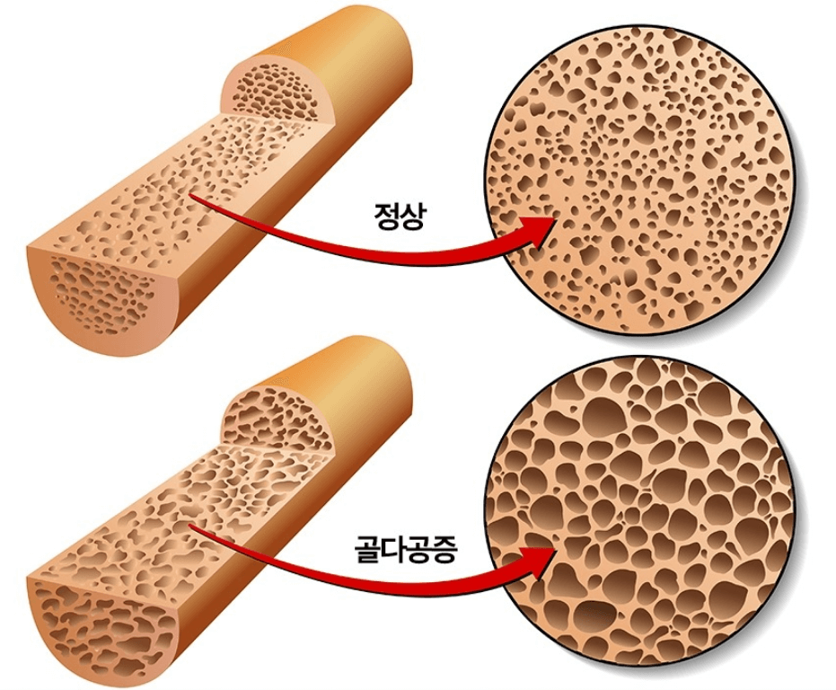 골다공증-사진