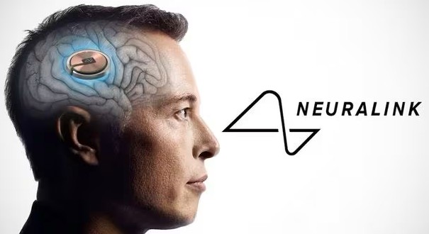 뉴럴링크 칩 이식