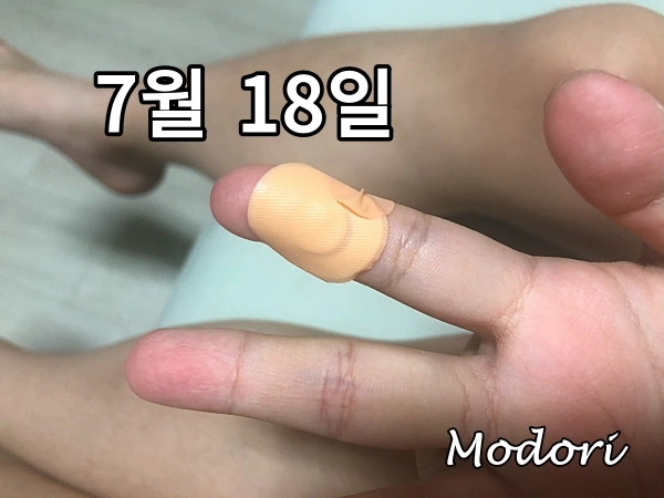 손가락이 작아 티눈밴드가 너무 큰 상태
