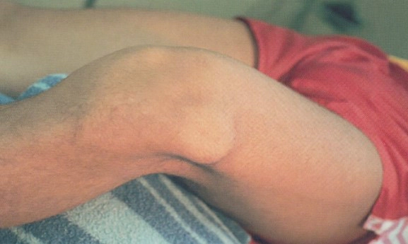 슬개골 탈구 재활 Tip