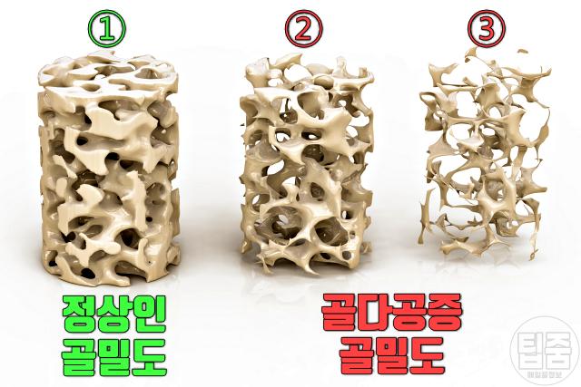 골다공증 증상 초기증상