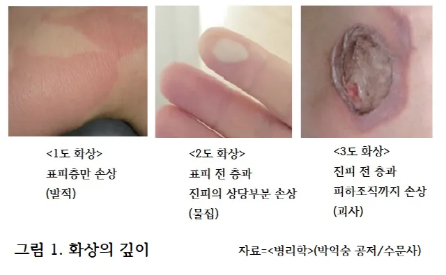 2도 화상 증상 자가치료 회복기간 응급처치법 정리_8