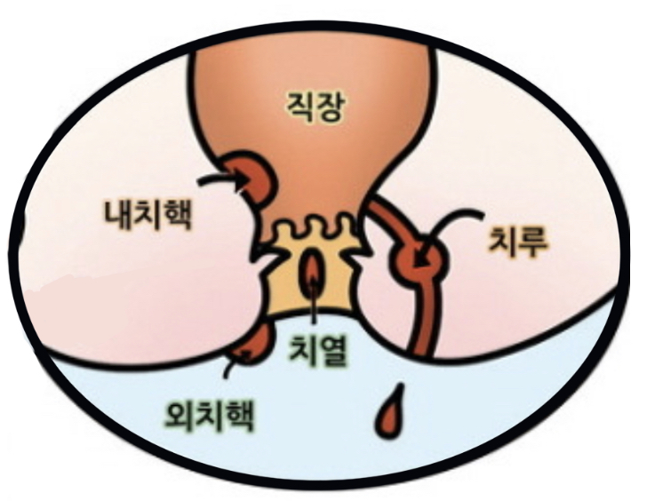 항문질환의_종류와_위치
