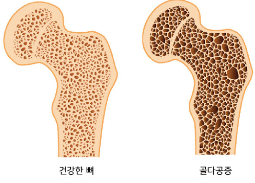 골다공증-뼈단면도