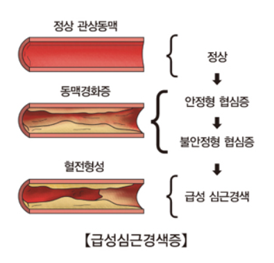 심근경색