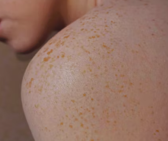 건선 초기 증상 피부염 원인 치료방법