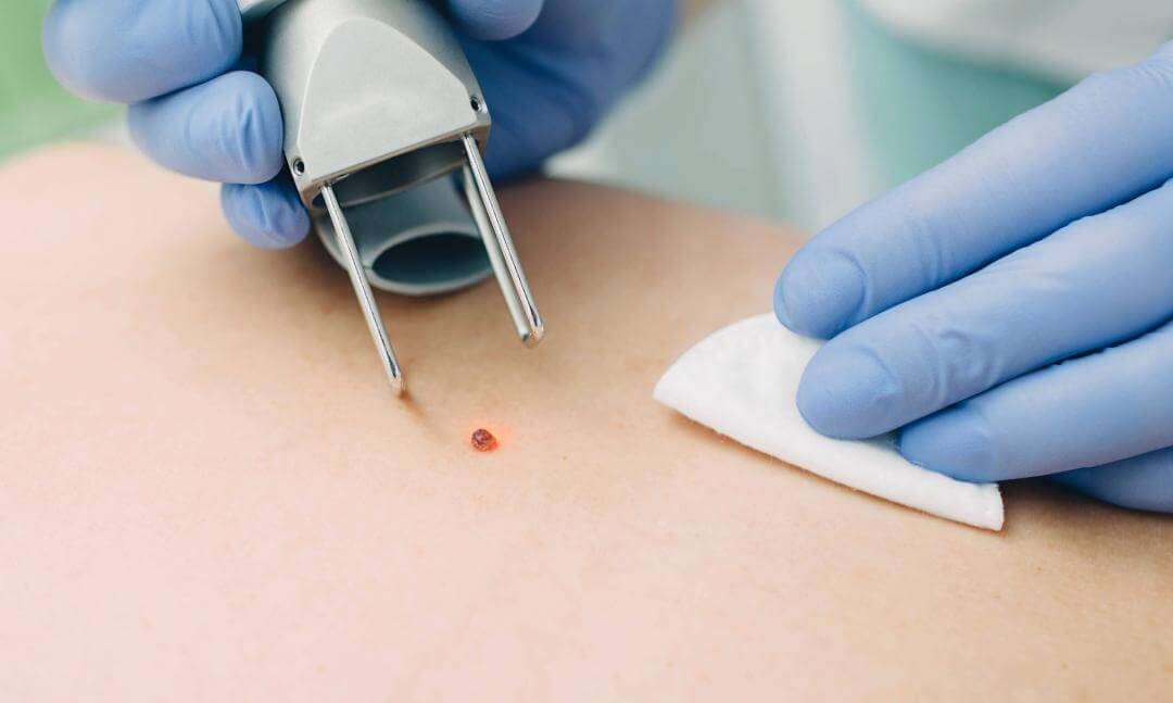 쥐젖이 생기는 이유