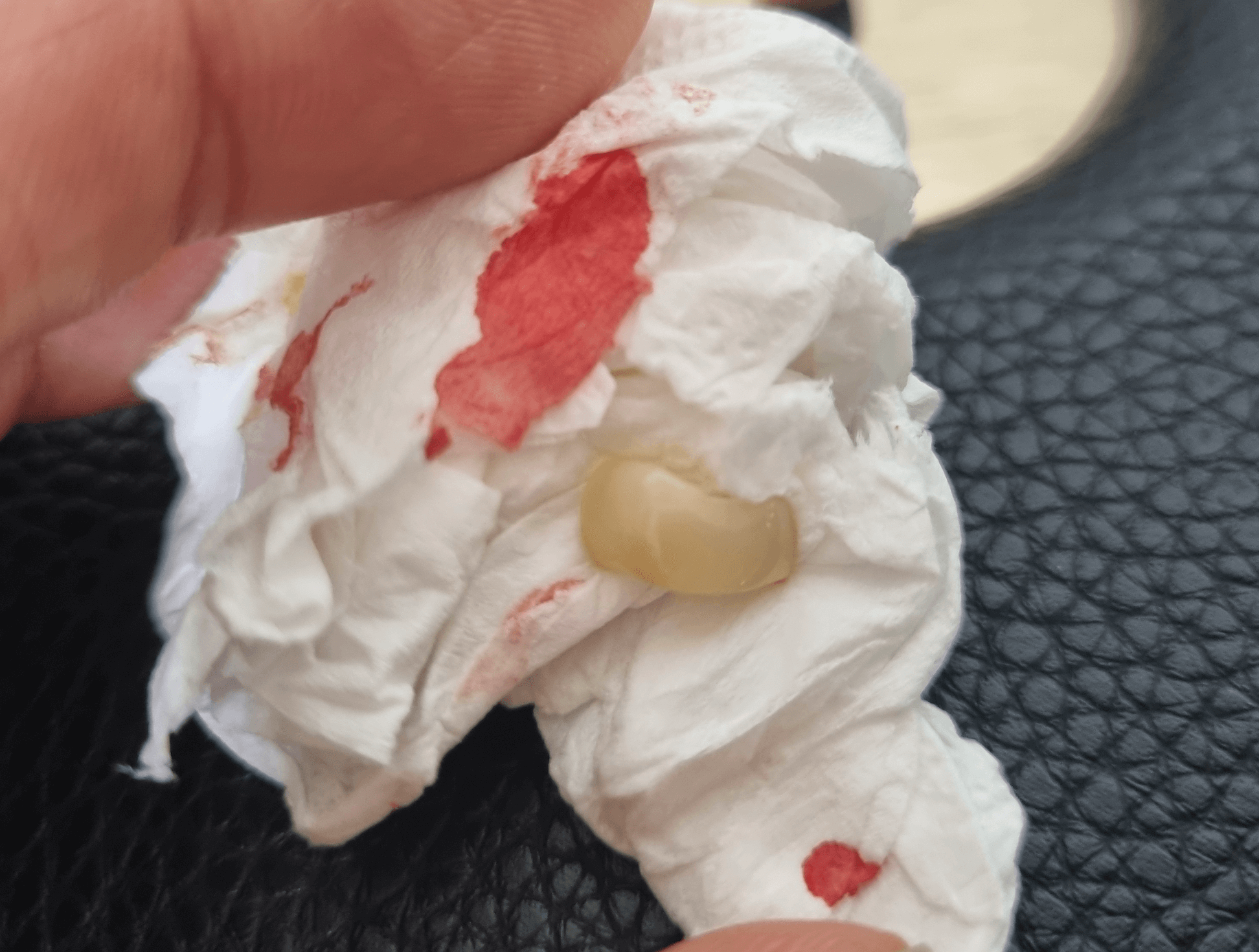 지르코니아 크라운