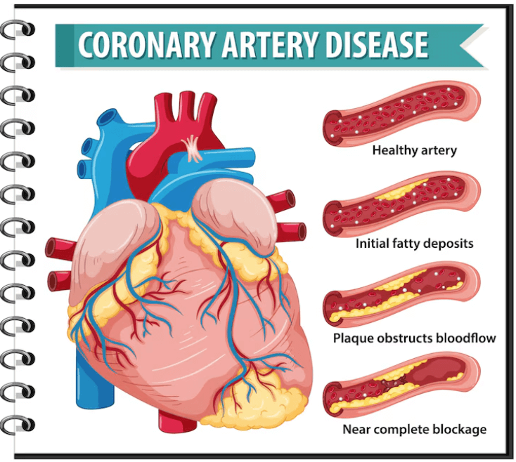 혈관에 머물러 있는 혈관 찌거기