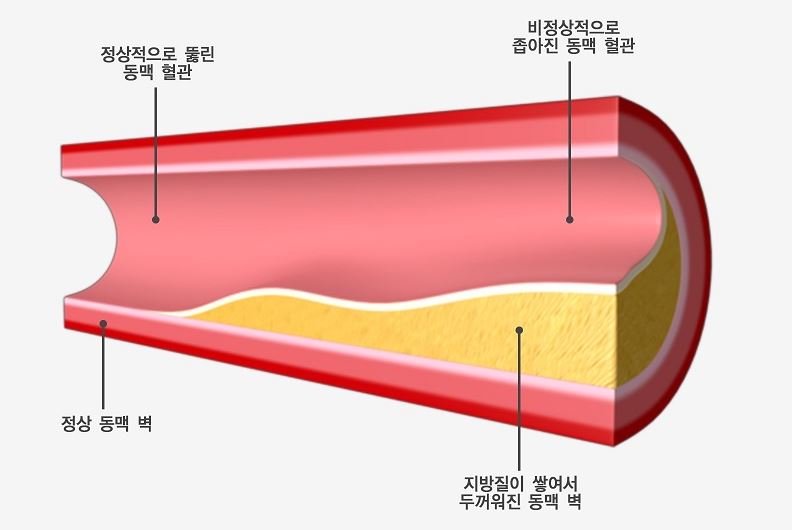 동맥경화증-혈관의-예시-그림