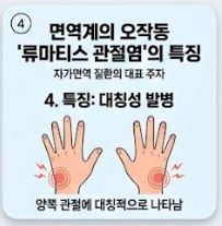 류마티스 관절염 초기증상