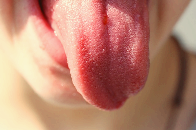 혓바늘 원인 없애는법 알보칠