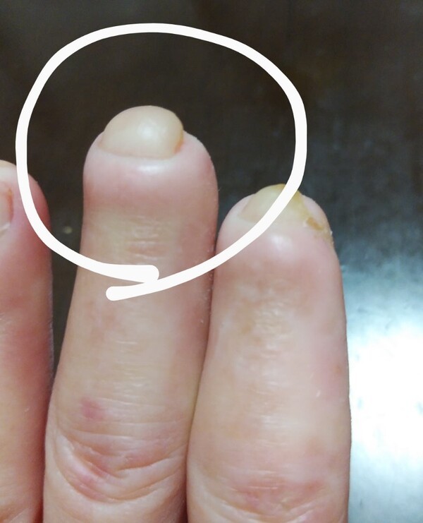 손가락이 ‘이 모양’ 이라면… 당장 병원부터 가세요.