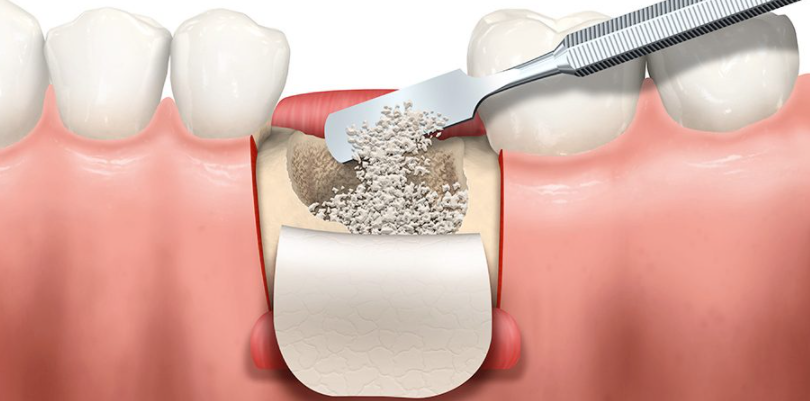 임플란트-추가비용