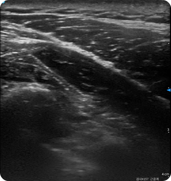 구로디지털단지 어깨 초음파