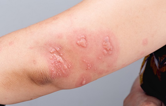 The area around the shingles