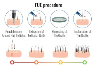 모발이식-절개-비절개-3