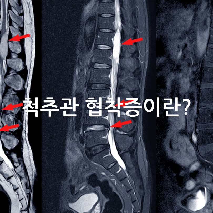 허리 협착증에 좋은 운동