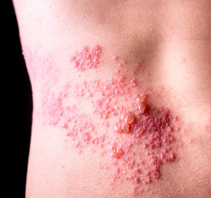 대상포진 예방접종 종류