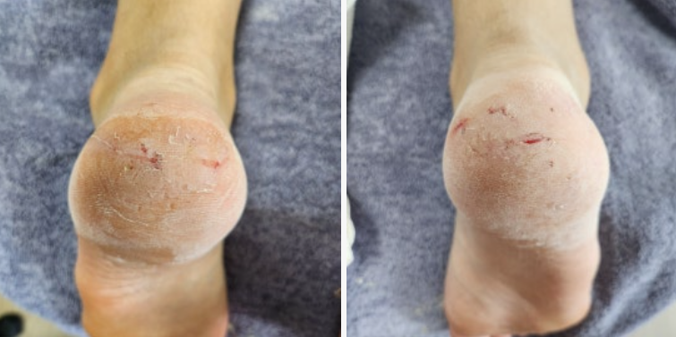 어성초 필리프 풋 패치 내돈내산 후기