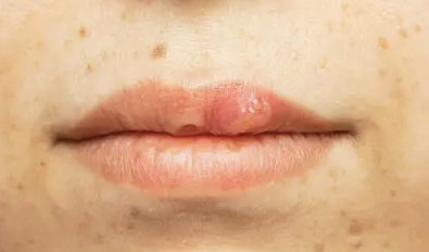 입술에 물집이 생기는 이유 3