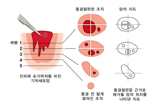 식도암